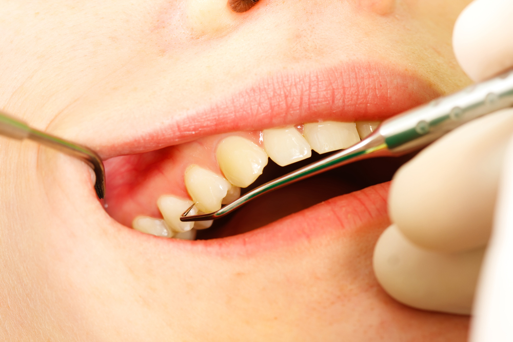 Wurzelbehandlungen: Endodontie ist eine Wurzelkanalbehandlung